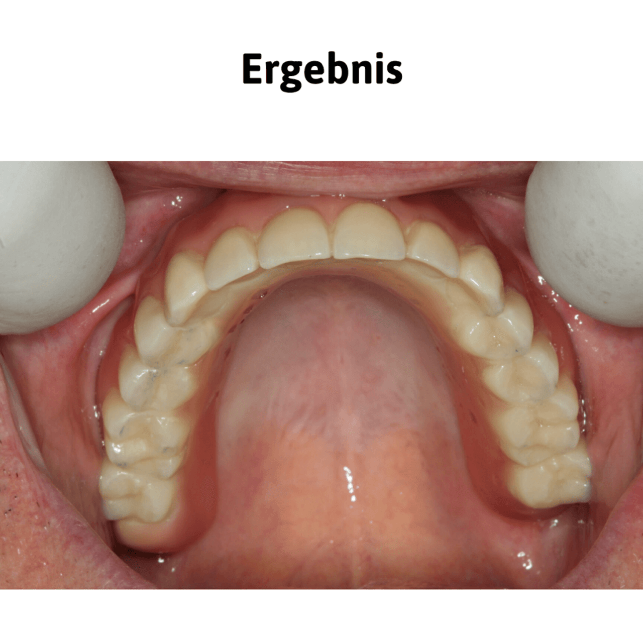 Ergebnis: fertiger Teleskopzahnersatz